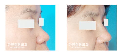 융비술