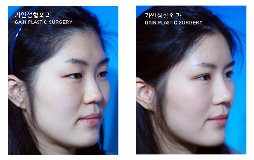 코성형 / 이마지방주입 / 부분절개법 