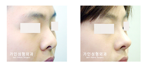 코재수술