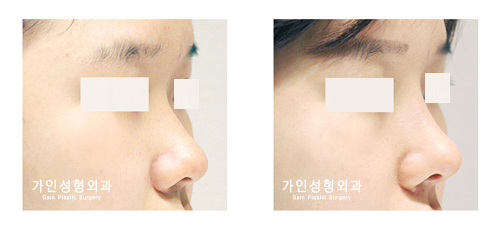 코재수술