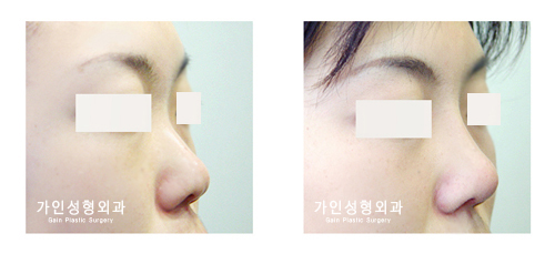 코재수술