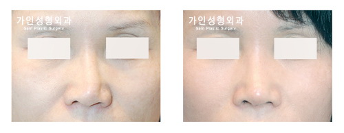 코재수술