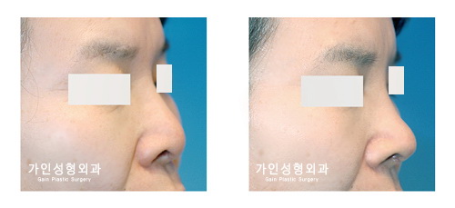 코재수술