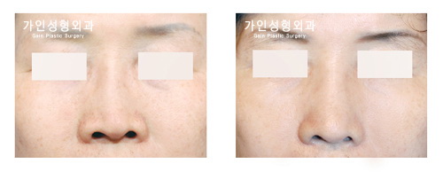 코재수술