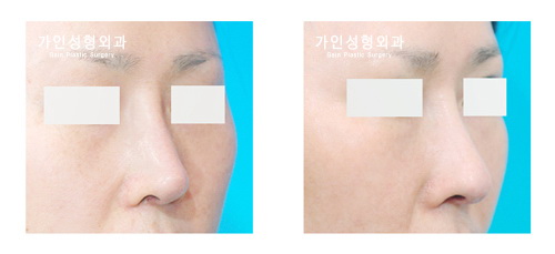 코재수술