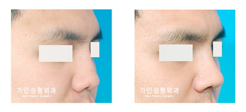코재수술