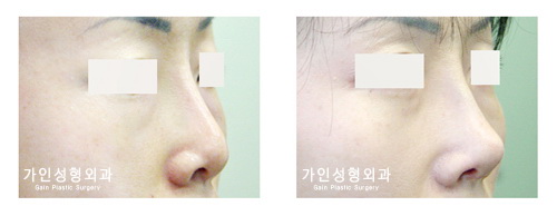코재수술