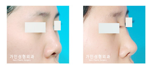 코재수술