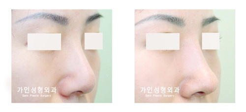 코재수술