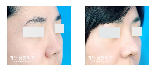 코재수술