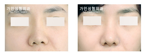 코재수술