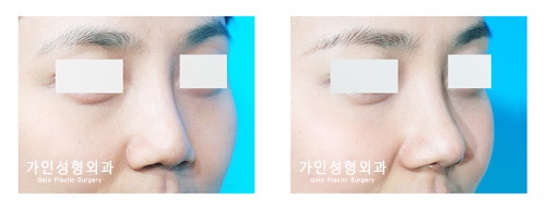 코재수술