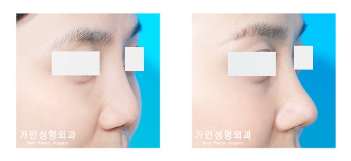 코재수술