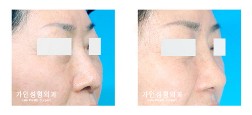 코재수술