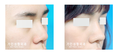 융비술