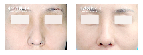 휜코