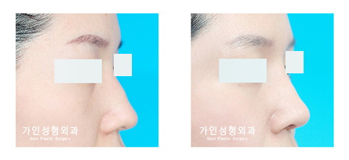 매부리코