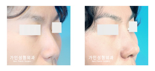 매부리코
