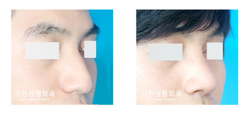 매부리코