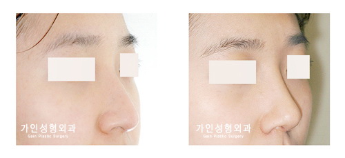 매부리코