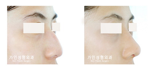 매부리코 / 코끝올리기