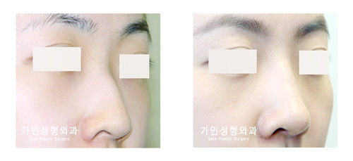 매부리코