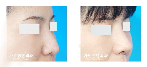 매부리코