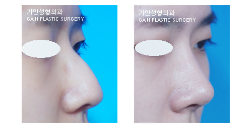 보형물사용 NO!/절골술/매부리코 