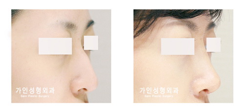 매부리코