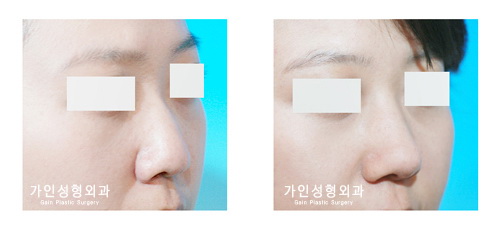 매부리코