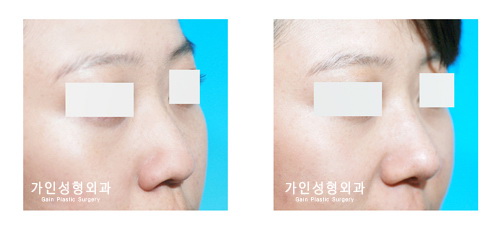 매부리코