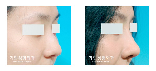 매부리코