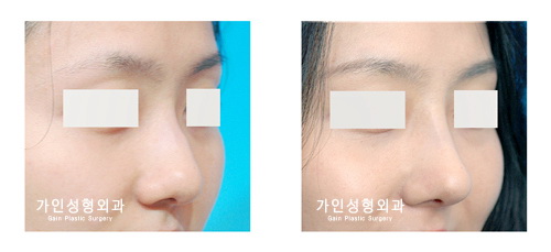 매부리코