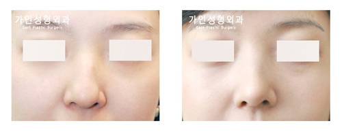 매부리코