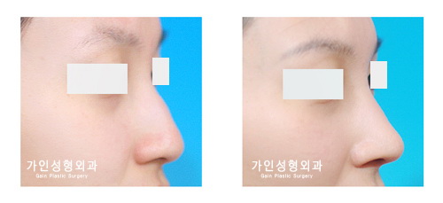 매부리코