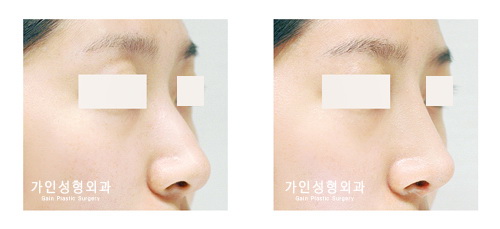 매부리코