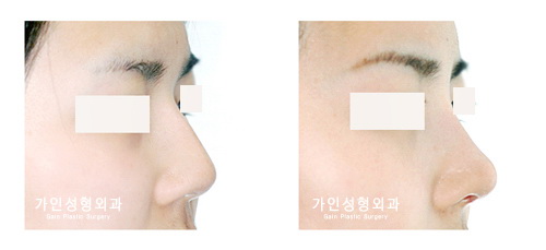 매부리코