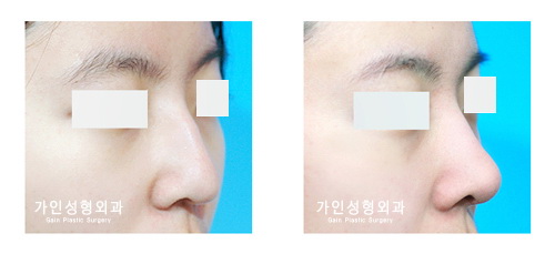 매부리코