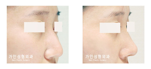 매부리코