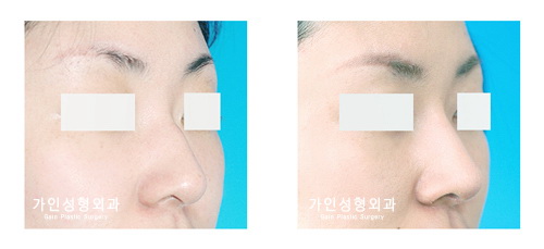 매부리코