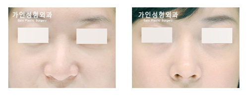 긴코-화살코