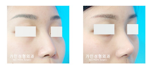 융비술