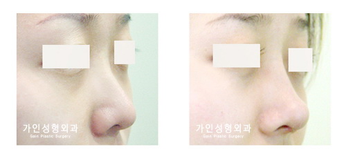 융비술
