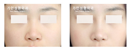 융비술