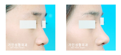 융비술