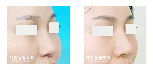 융비술