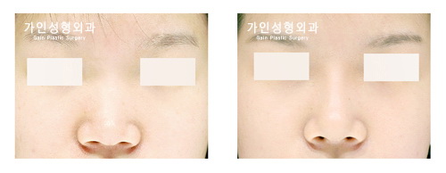 융비술