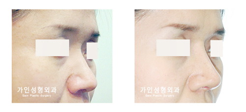 융비술