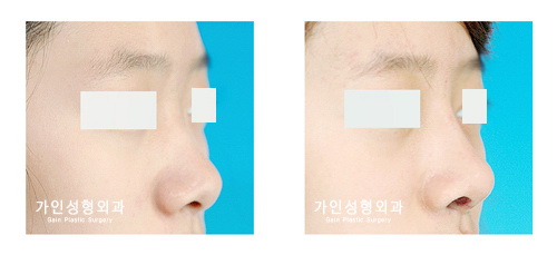 융비술