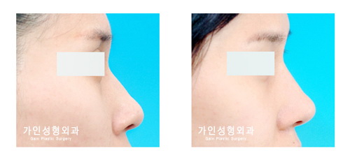 융비술